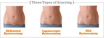 Bikini After Hysterectomy - richmondmagazine.com