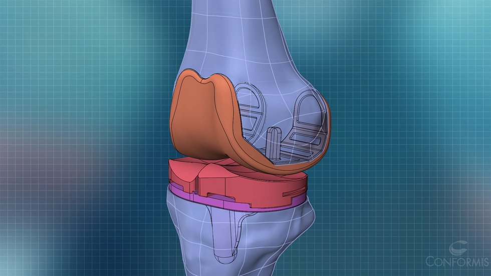 3-D Knee ConforMIS 2