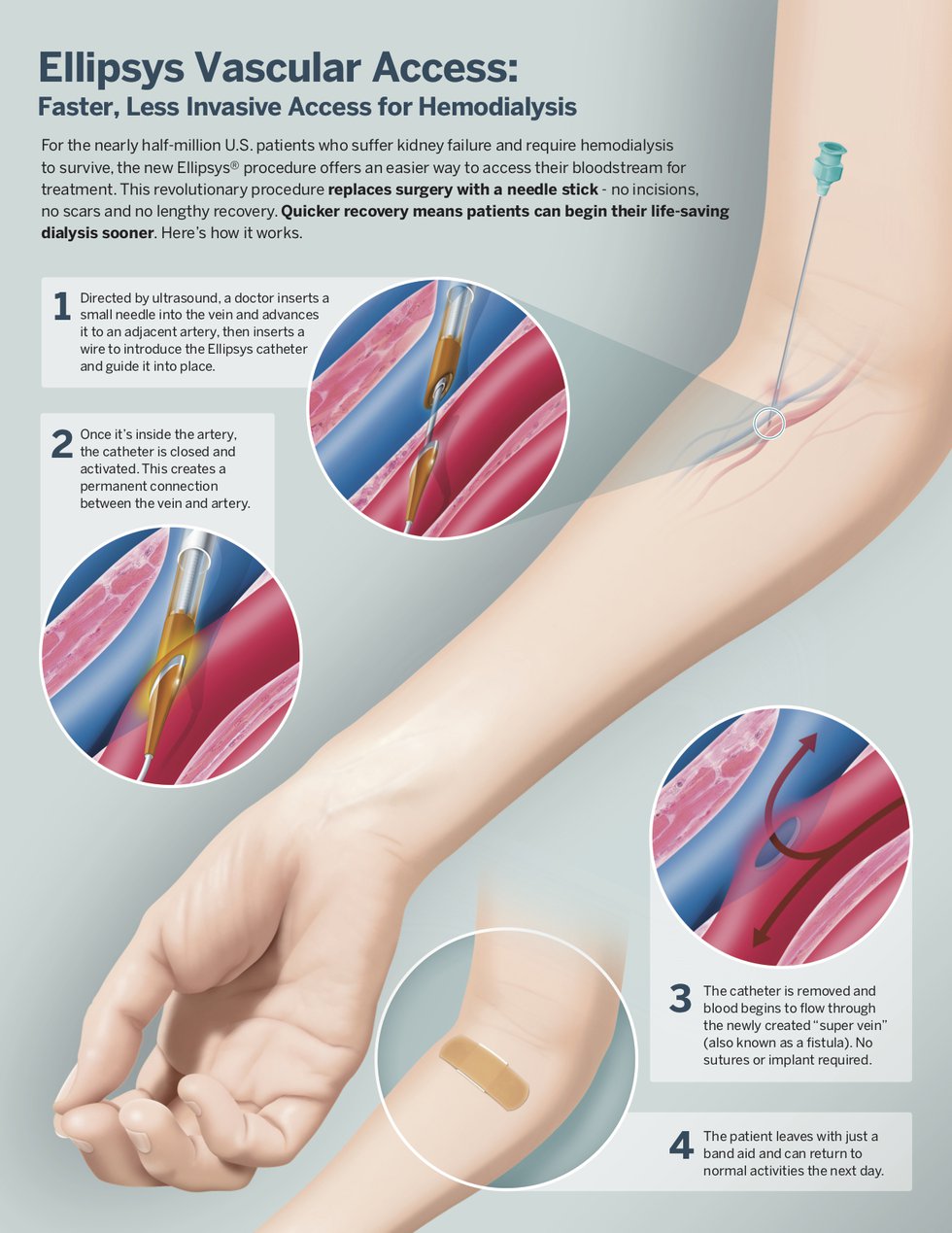 Ellipsys-Infographic-courtesy-avenu-medical.jpg